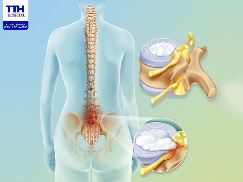 THOÁT VỊ ĐĨA ĐỆM LÀ GÌ? CÁC PHƯƠNG PHÁP ĐIỀU TRỊ BỆNH HIỆU QUẢ NHẤT